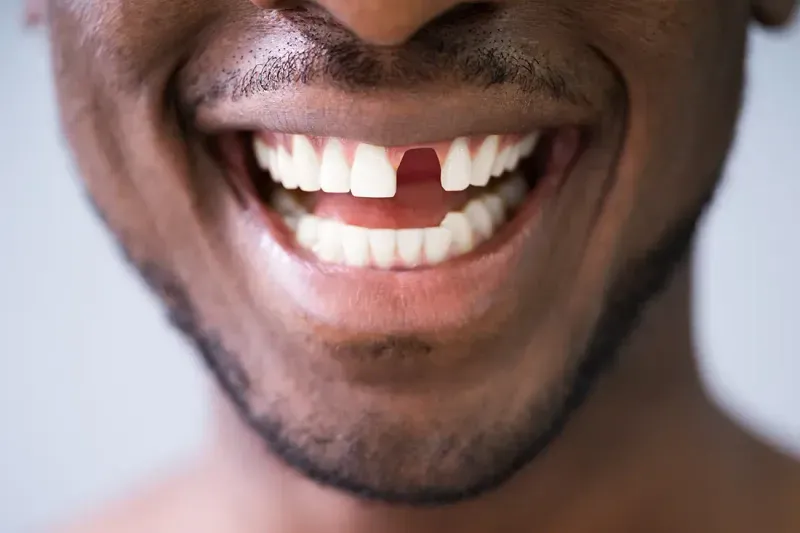 patient missing tooth