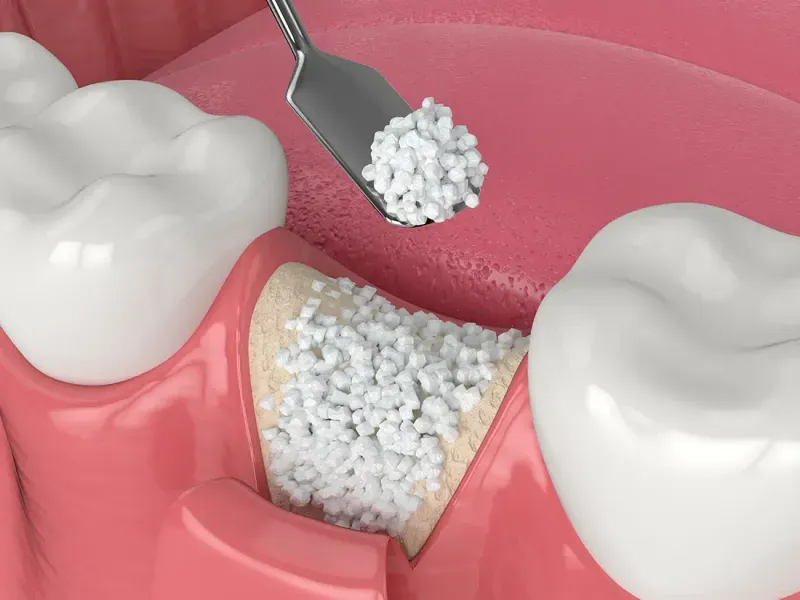 Dental bone grafting for implant