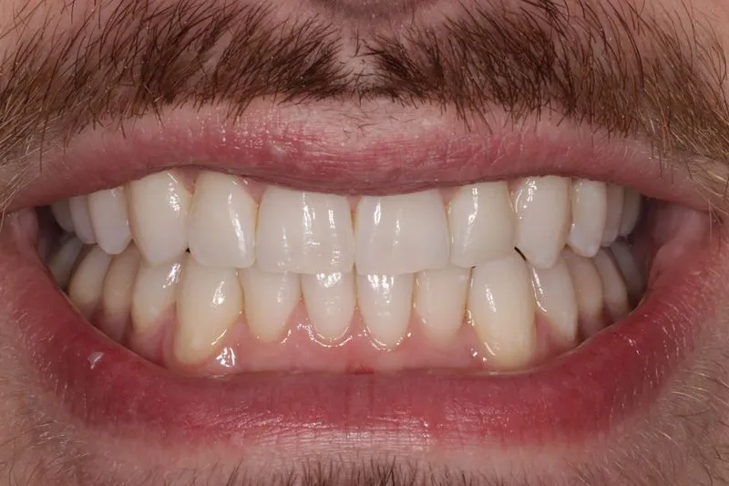 Patient photo after Invisalign in Leawood