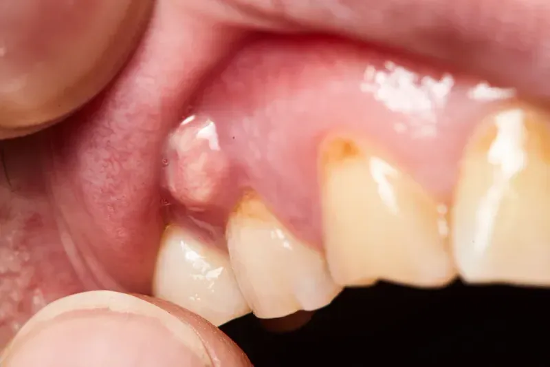 Dental abscess close-up