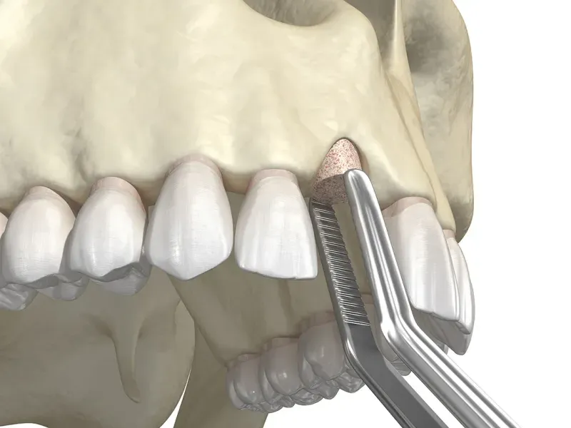 Bone grafting oral surgery