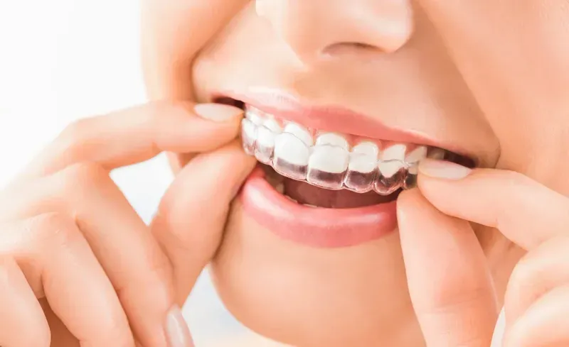 Patient fitting Invisalign aligner