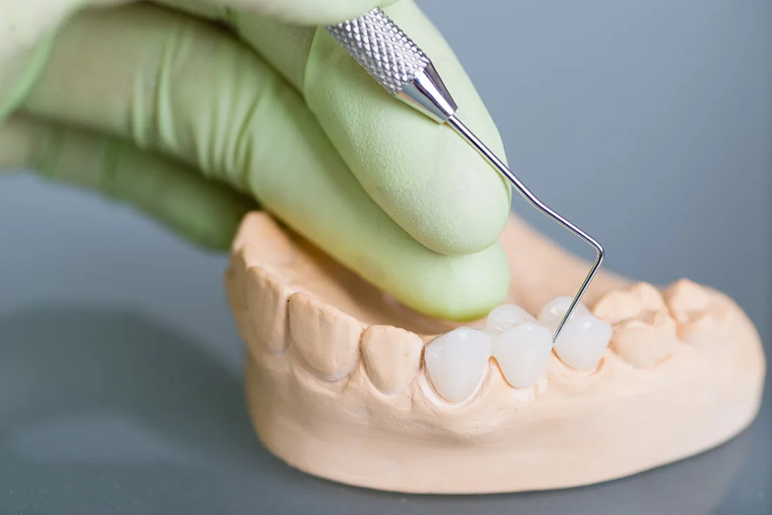 Dental bridge fitting model