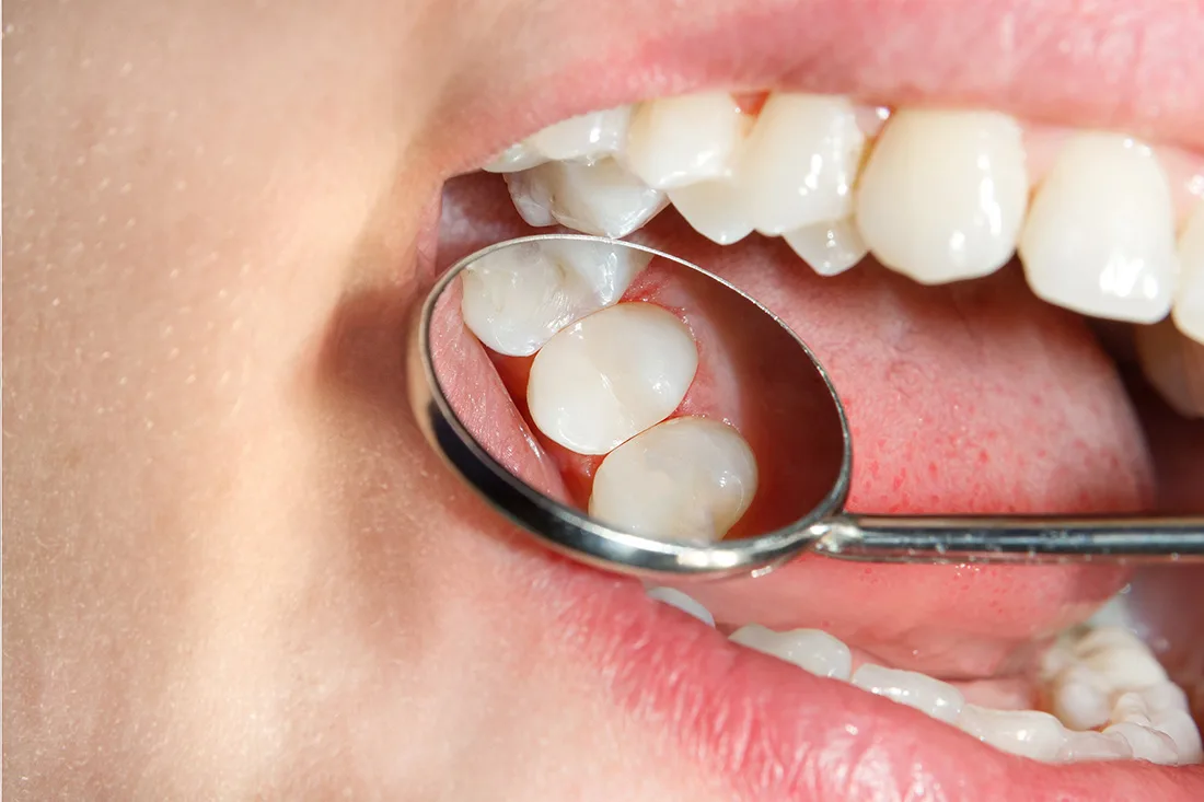 Dental mirror examining tooth filling