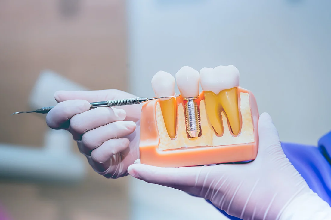 Dental implant model