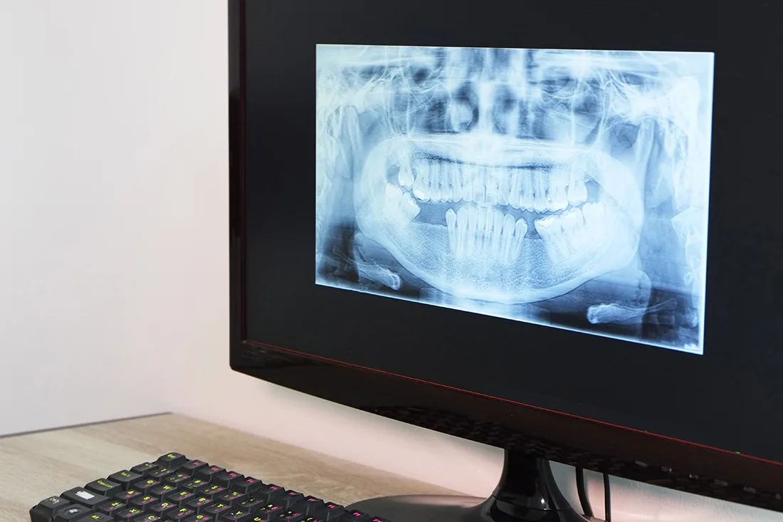 Digital dental x-rays