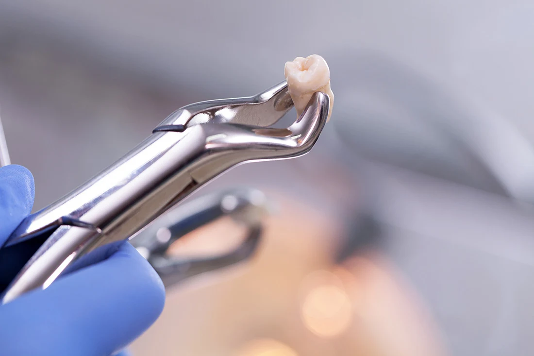 Tooth extraction with dental forceps