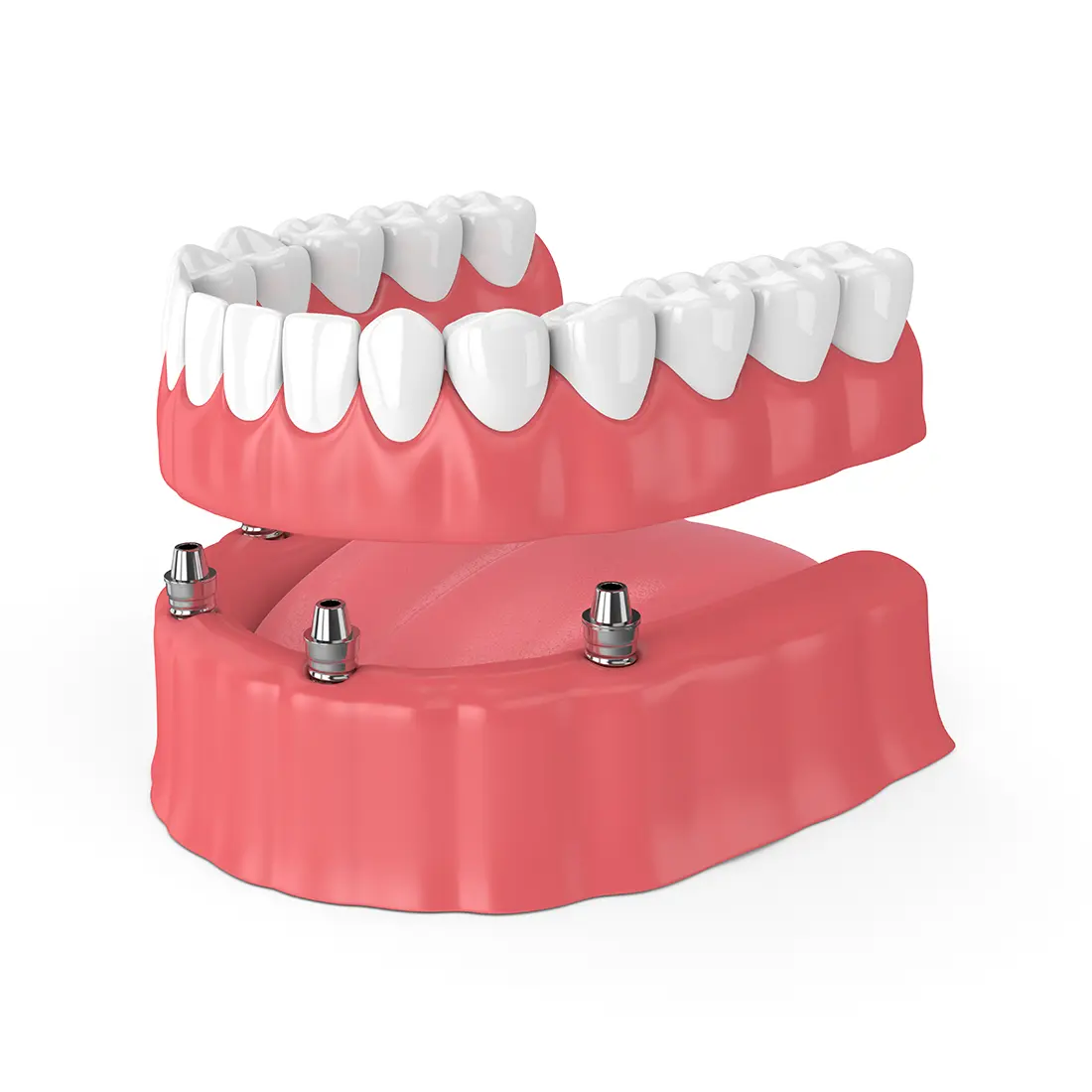 Implant-retained dentures