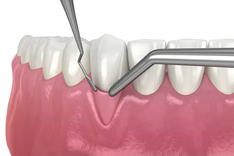 Soft tissue grafting procedure