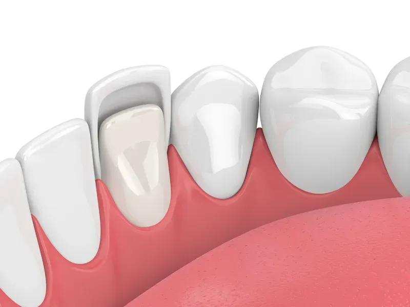 Tooth porcelain veneer application