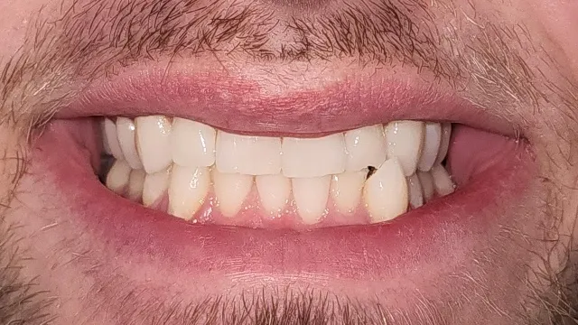 Invisalign before patient photo