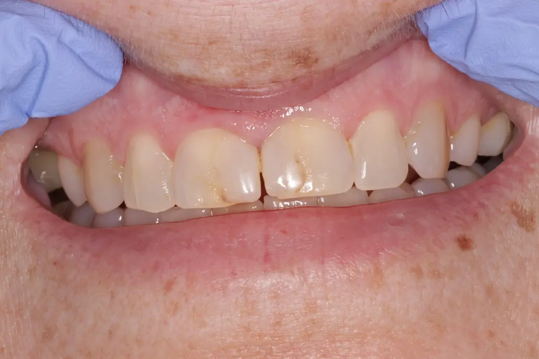 Patient photo before composite veneers