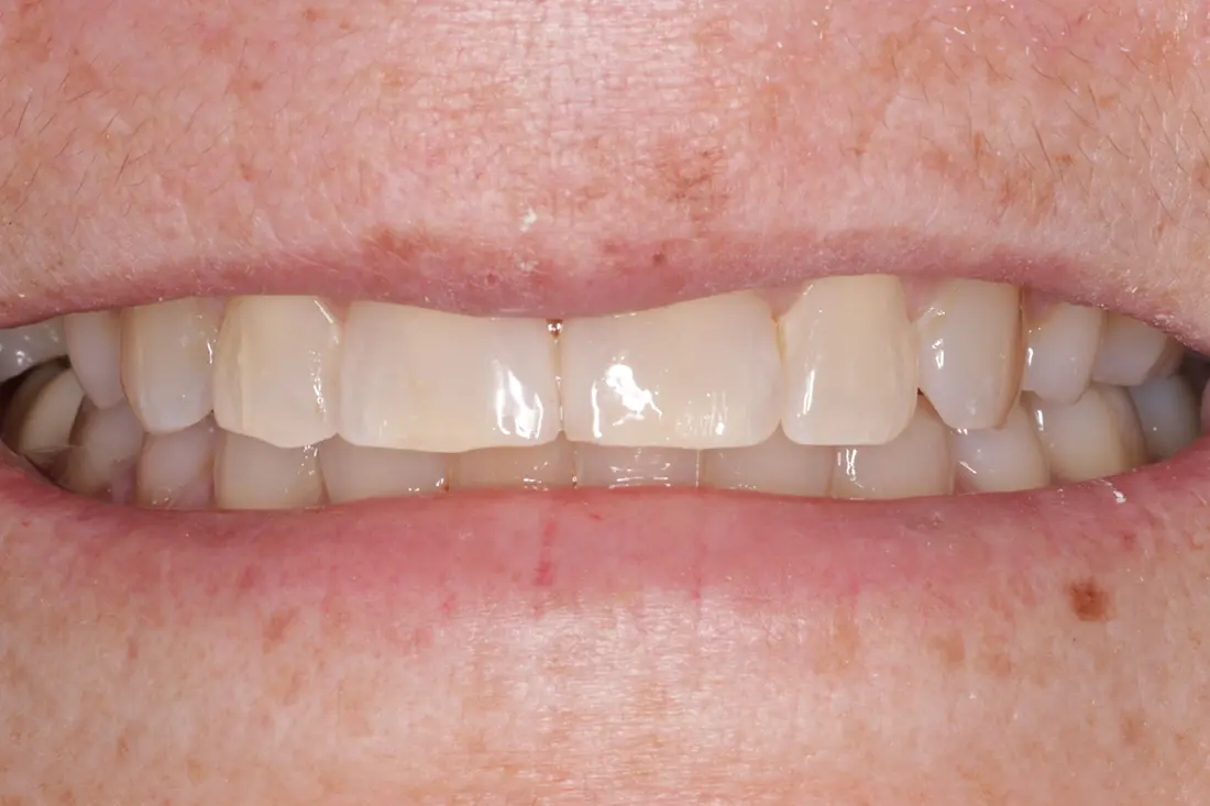 Patient photo after composite veneers