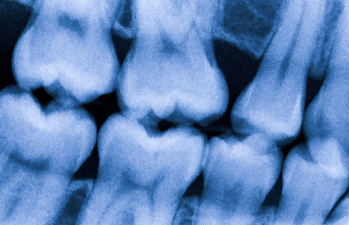 Digital dental x-rays