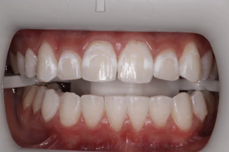 Before Icon Resin Infiltration