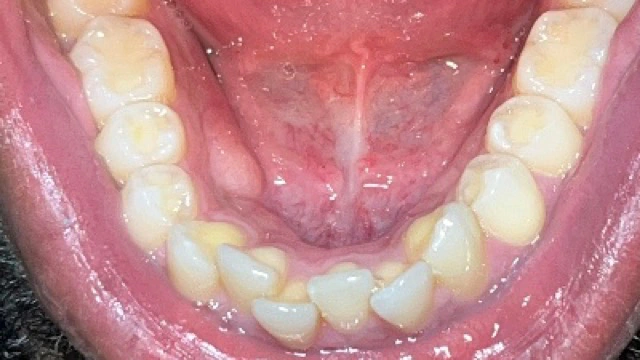 invisalign before