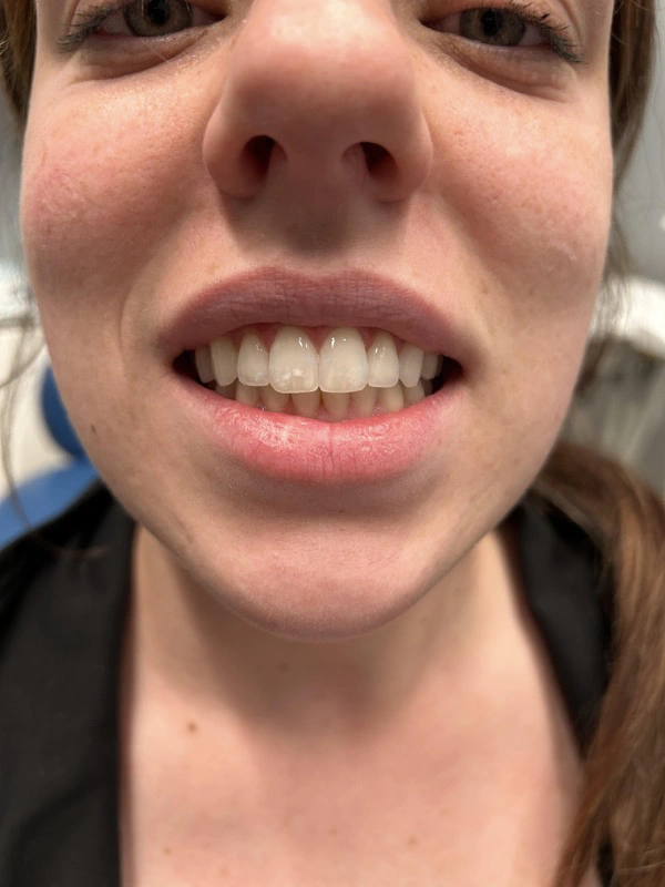 After Invisalign