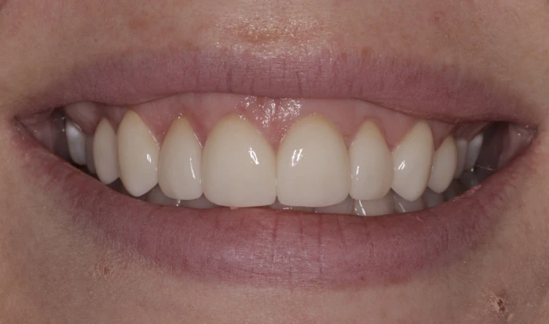 After Veneers