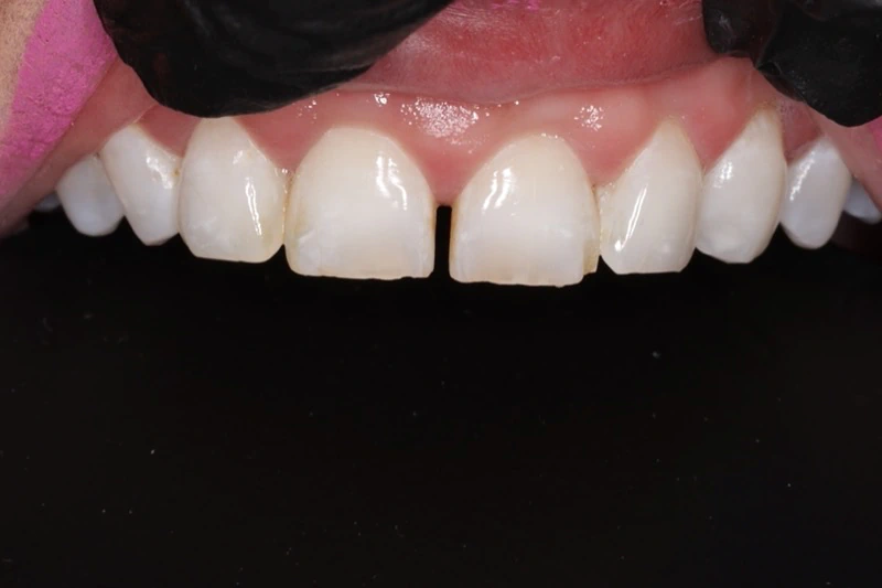 Before Composite Bonding