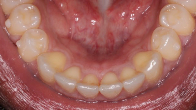 invisalign after