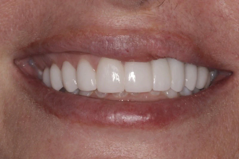 Smile Makeover After