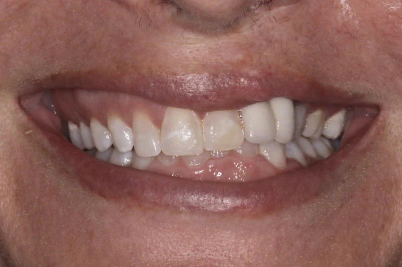 Smile Makeover Before