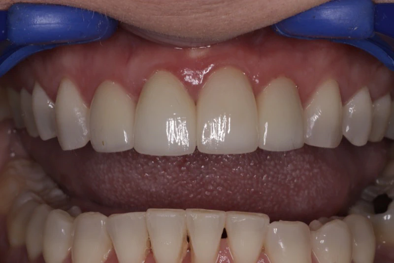 After Veneers