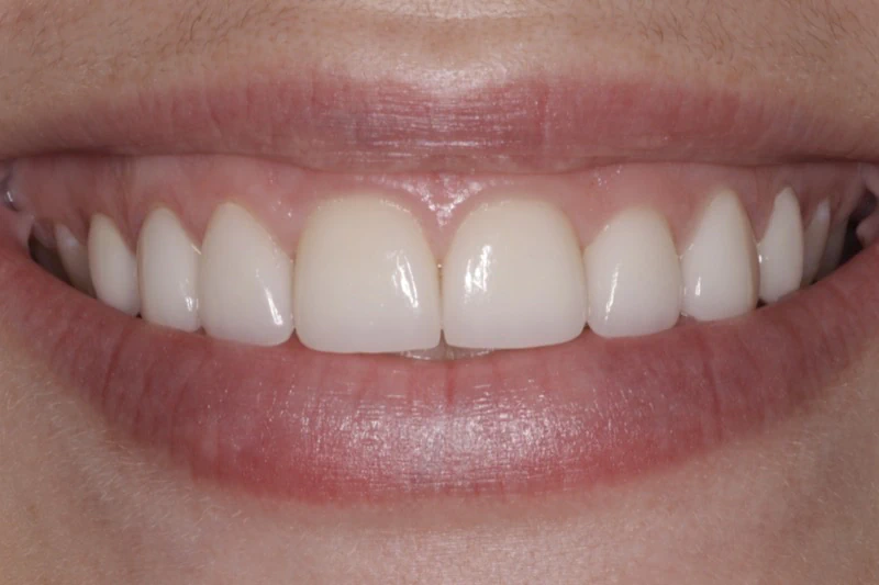 After Veneers