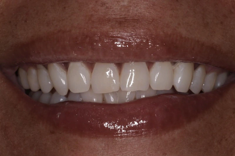 After Zoom Whitening