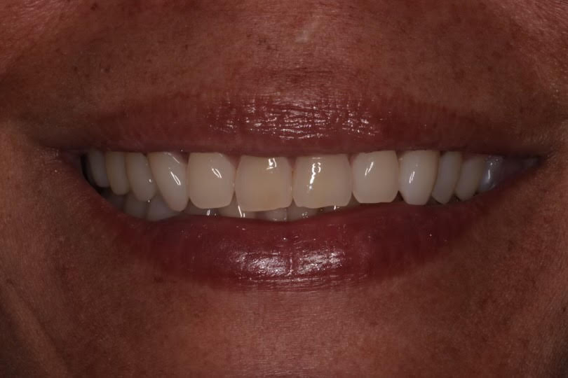 Before Zoom Whitening