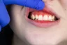 Are Bleeding Gums a Dental Emergency?